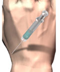 cortisone injectie