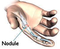 nodule