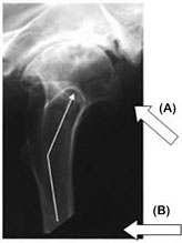 afwijkende anatomie heupdysplasie