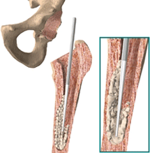 cement uit femur verwijderen