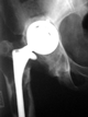 osteolyse rond de cup en de steel