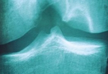 RX opname toont een groot chondraal (kraakbeen) letsel van het bovenbeen gewrichtsoppervlak