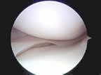 meniscus