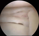 meniscus