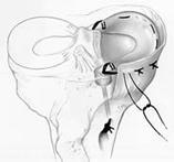 meniscus transplantatie