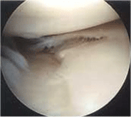 scheur van de meniscus