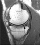 NMR meniscus