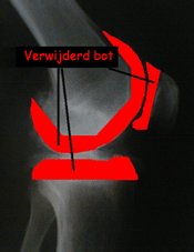 het rode gedeelte toont de minimale hoeveelheid bot die 