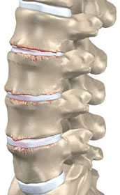 degeneratie tussenwervelschijven