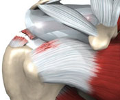 rotator cuff letsels