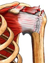 Rotator cuff scheuren 